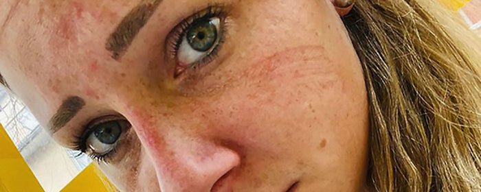 Franziska Nordmann face mask scars