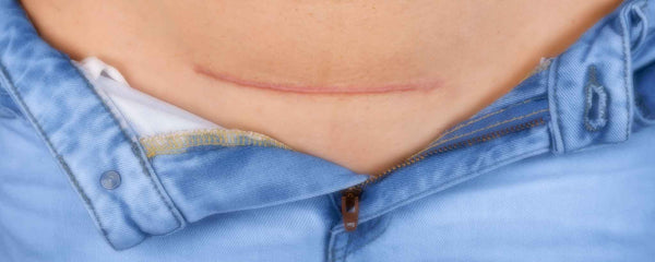 Horizontal C-section scar