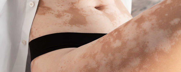 Vitiligo on stomach and thighs