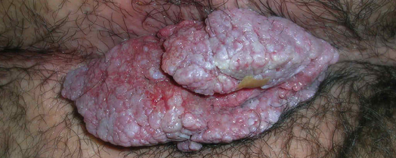 Large wart covering genitalia