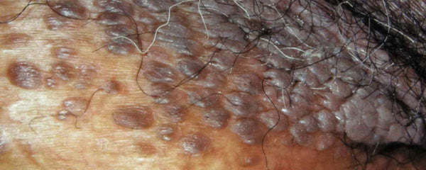 Female vulval warts