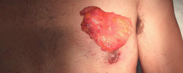 Male gynecomastia excision