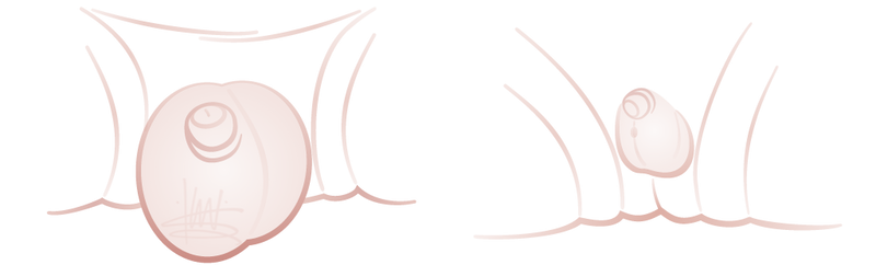 Hydrocele