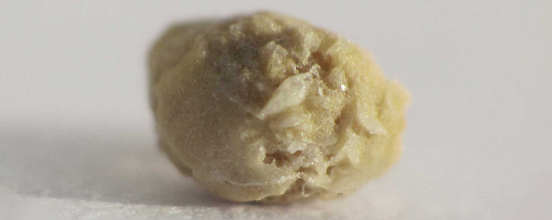 Kidney stone 4mm
