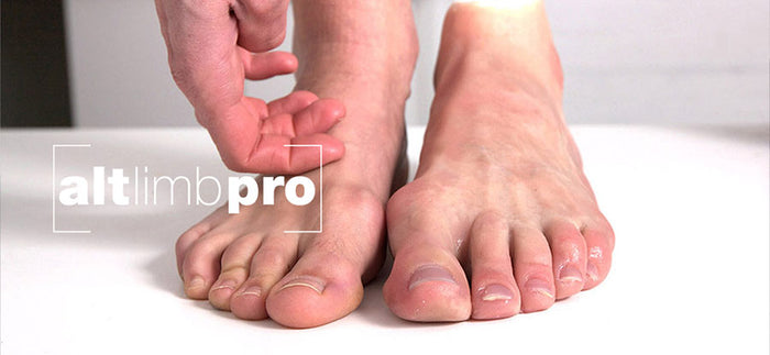 Where Do We Stand On Prosthetics? - Alternative Limb Project