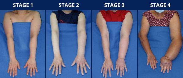 Lymphedema Stages