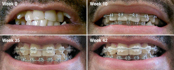 Maxillary cuspid braces