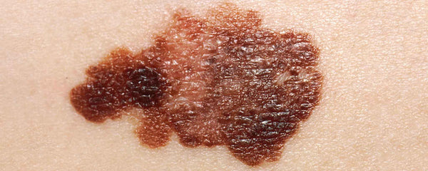 Melanoma