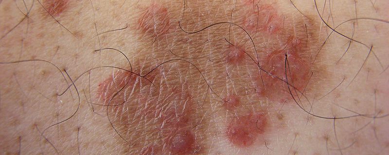 Mold causes skin rashes
