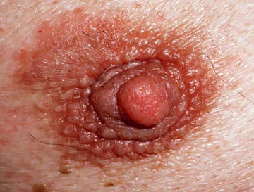 Nipple Eczema