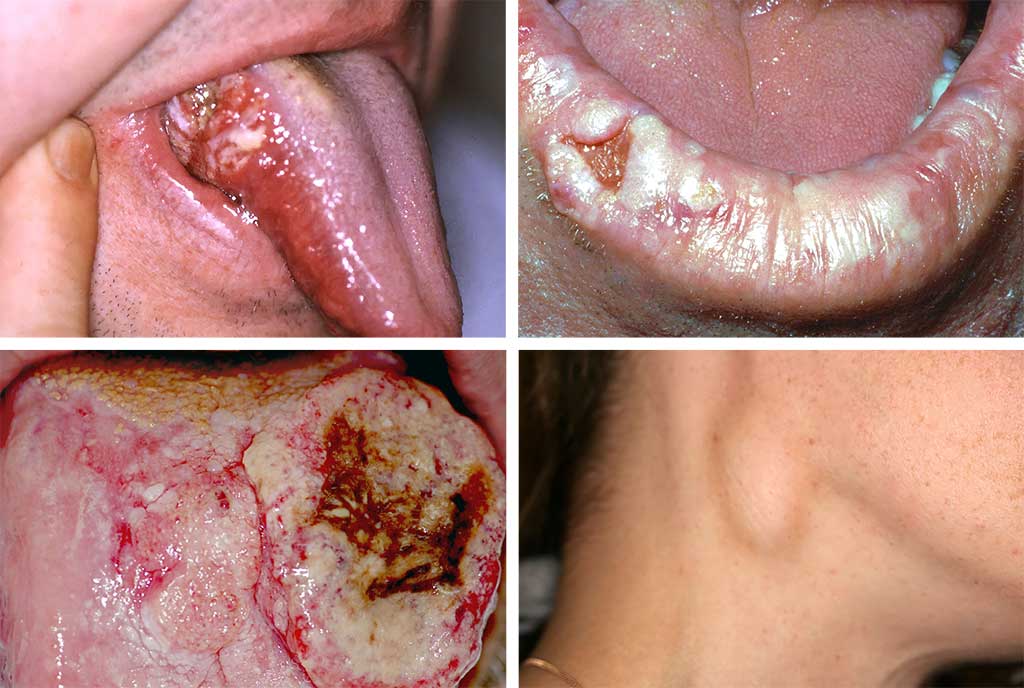 Oral cancer photos