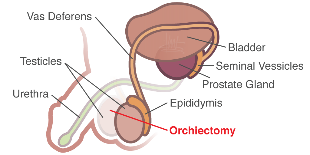 Treatment For Testicular Cancer