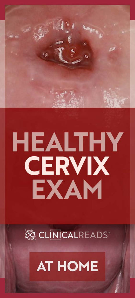 Healthy Cervix Exam