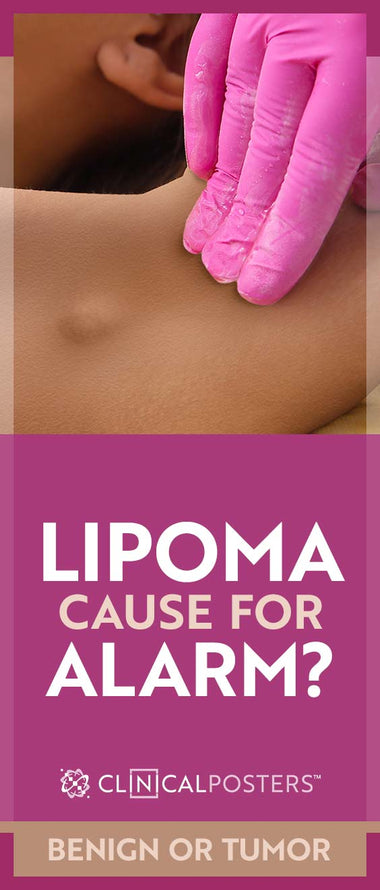 What is a Lipoma?