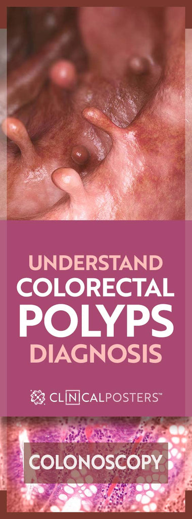Should You Worry About Colorectal Polyps?