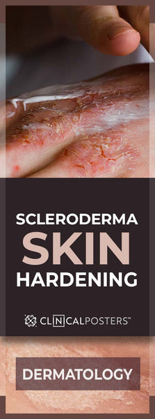 Hard to Feel Scleroderma