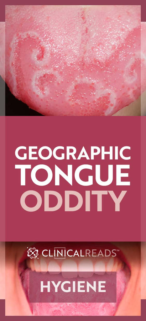 Pardon My Geographic Tongue