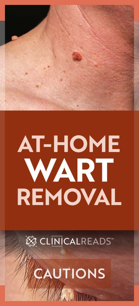 At-Home Wart Removal Cautions
