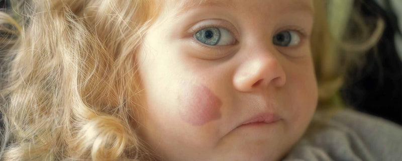 Baby with port-wine stain on cheek