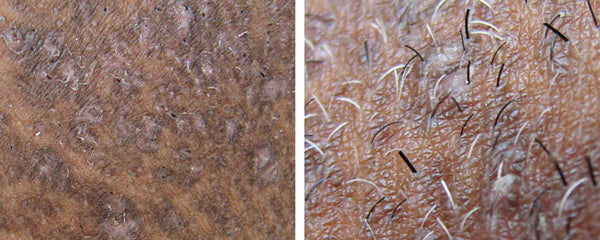 Pseudofolliculitis barbae