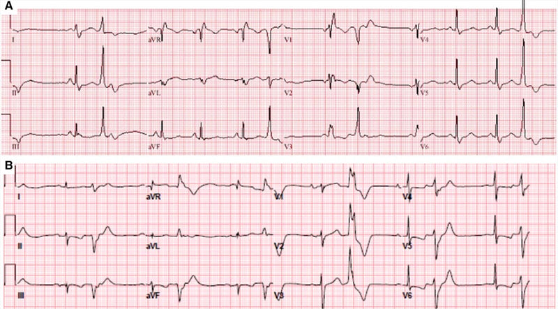 PVC electrocardiograph