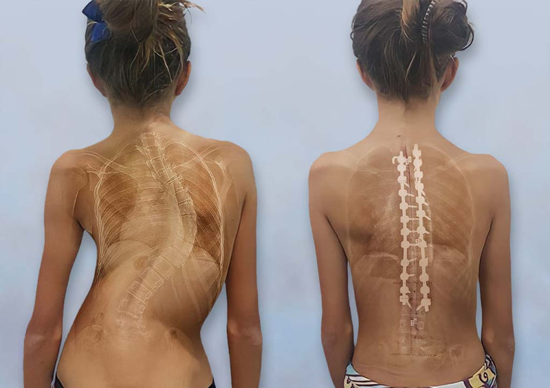 Scoliosis Surgery