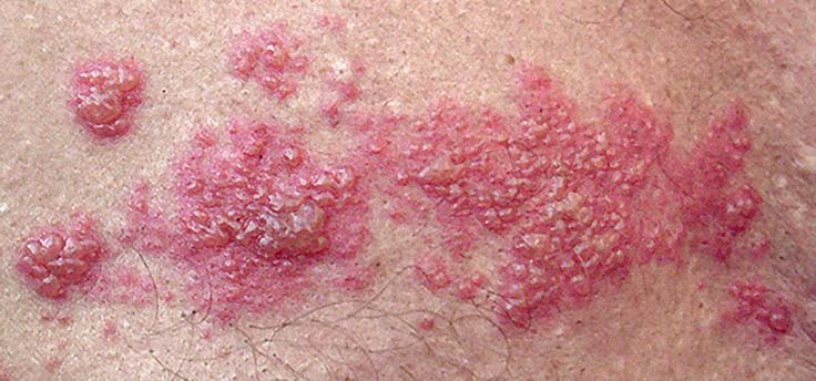 Herpes zoster shingles