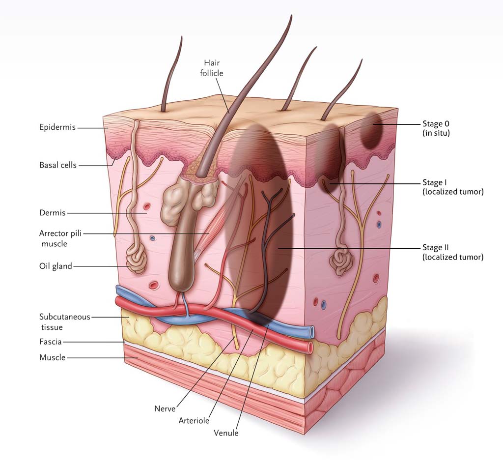 Skin Cancer Stages