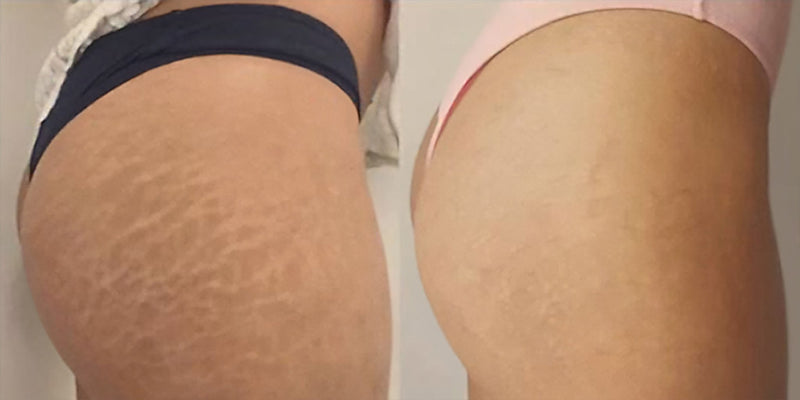 Stretch mark thigh