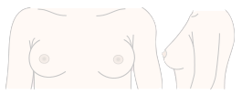 Tanner - Stage 5 breast development
