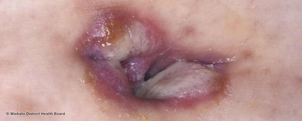 Umbilicus syphilis