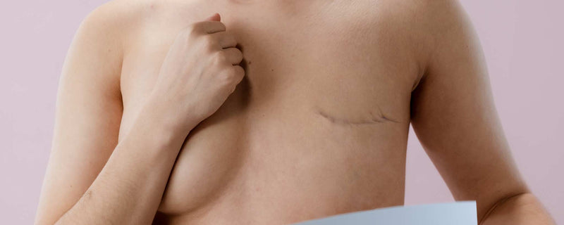 Unilateral radical mastectomy