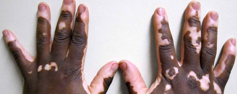 Vitiligo hands