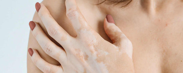 Vitiligo pale hand
