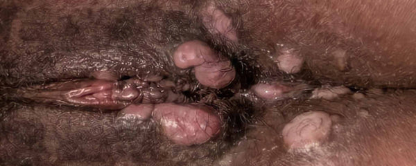 Vulval syphilis
