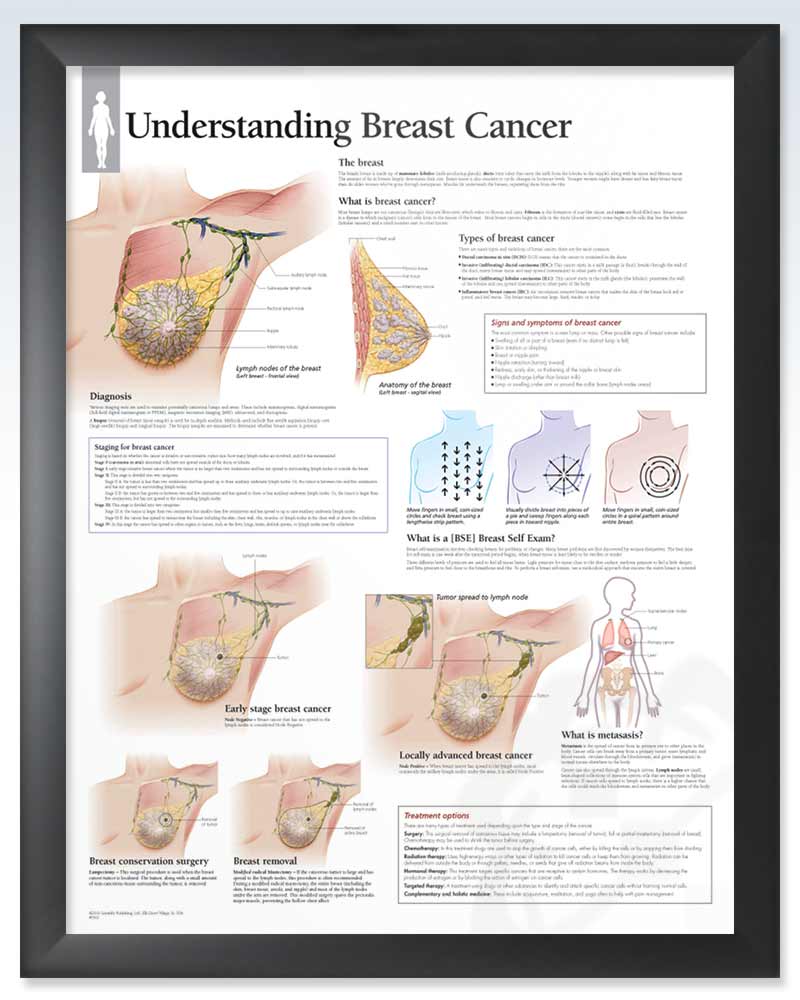 Understanding Breast Cancer Anatomical Chart