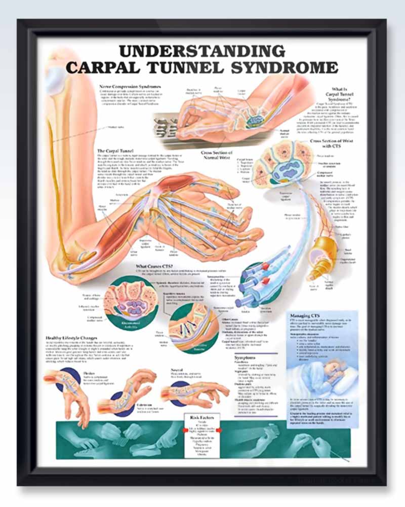 Carpal tunnel syndrome что это