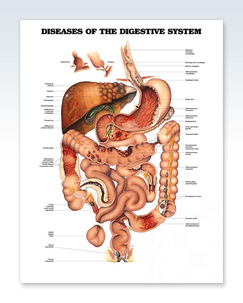 Ulcerative Colitis & Crohn's Disease Anatomical Chart Laminated:  9781496388209: : Books