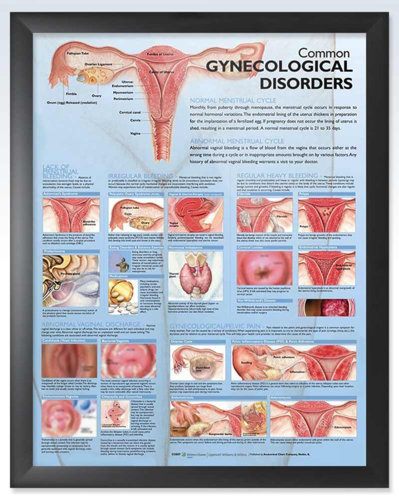 Gynecological Disorder Exam Room Anatomy Posters Clinicalposters 