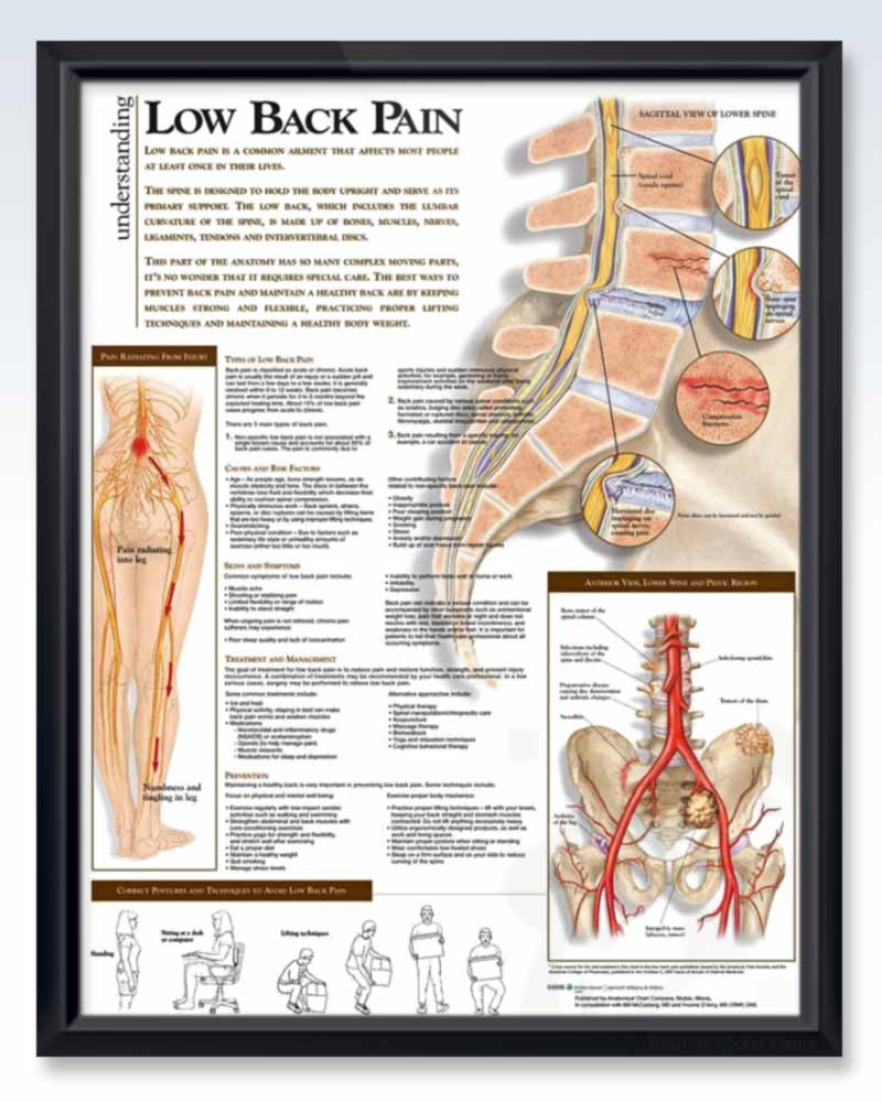 Low Back Pain Exam Room Anatomy Poster – ClinicalPosters
