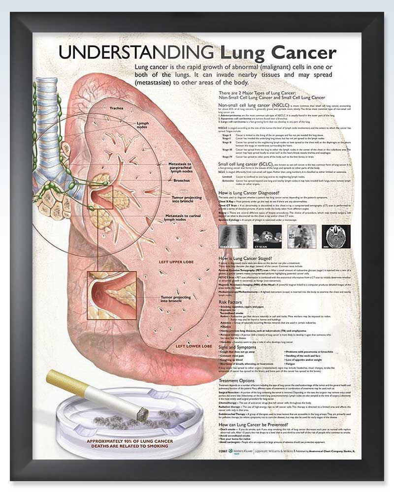 Lung Cancer Exam-Room Anatomy Poster – ClinicalPosters