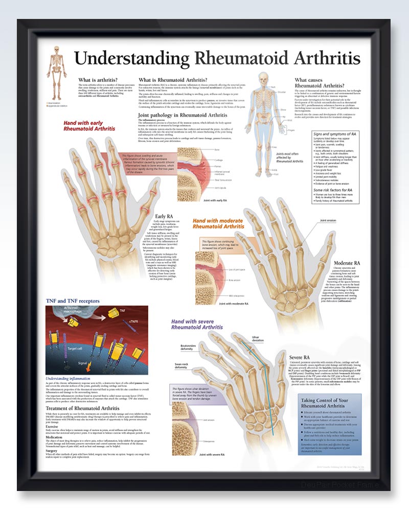 Rheumatoid Arthritis Exam Room Human Anatomy Poster Clinicalposters