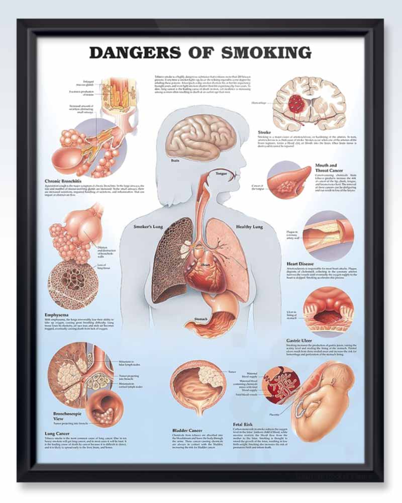 Dangers Of Smoking Human Anatomy Posters Clinicalposters
