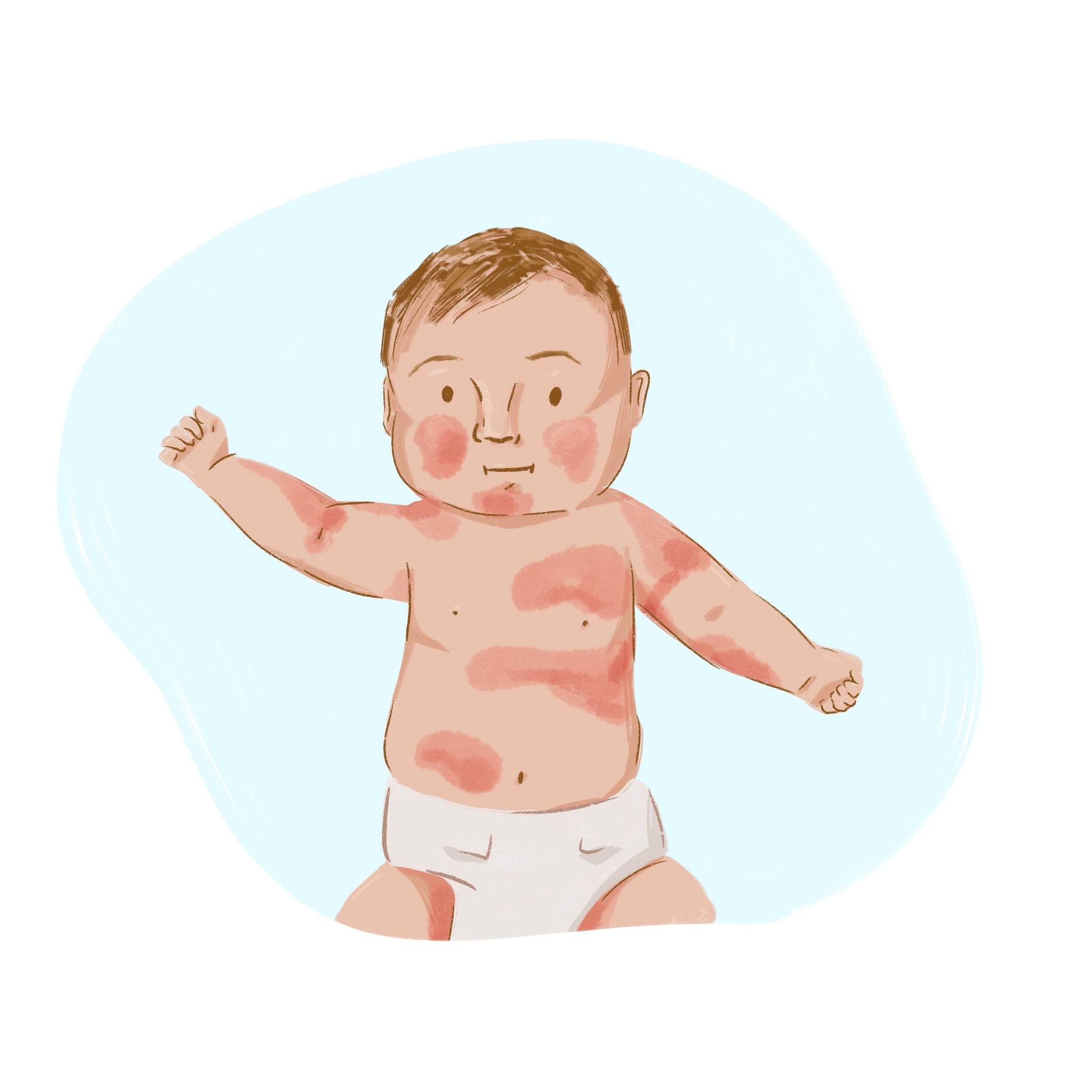 Babies And Eczema Everything You Need To Know Lil Mixins