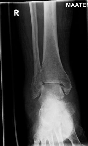 Earlier falls predict subsequent fractures in postmenopausal women