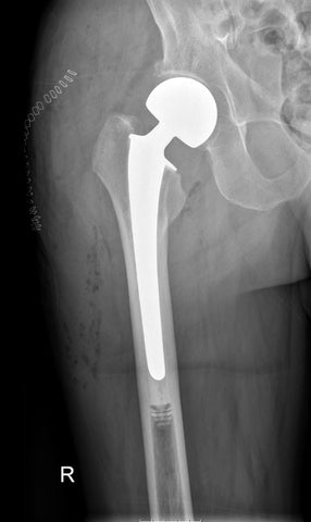 Many diseases increase the risks of hip fracture surgery