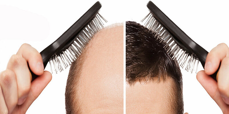 Hair Transplantation