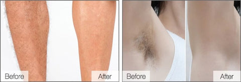 Timeless Beauty IPL Hair Removal Handset