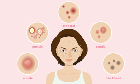 causes-of-blemishes