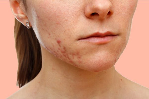 woman with acne